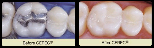 CEREC before and after, Glen Cove
